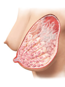 breast_1_illustration_verl