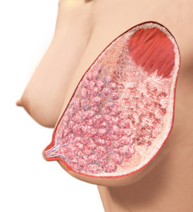 breast_4_illustration_small